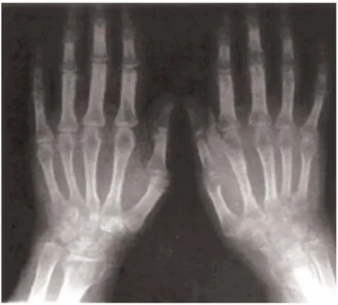 Figure 3: Radiographie d'une AD:  Poignet droit algodystrophique post-traumatique avec cliché du membre  controlatéral non atteint