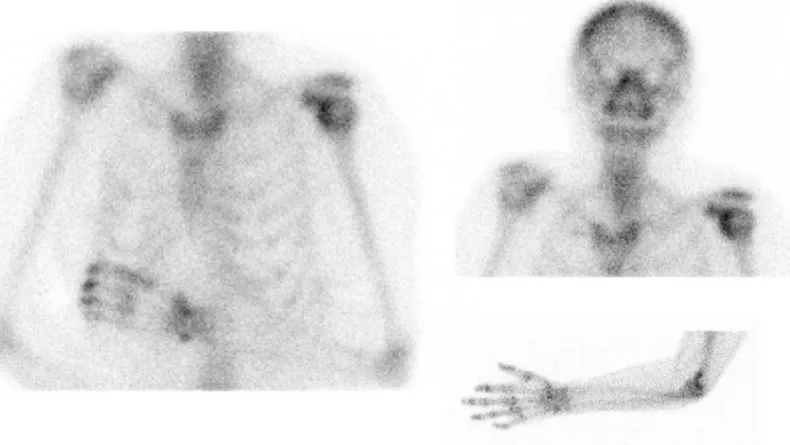 Figure 4: Scintigraphie osseuse de l’AD :  Scintigraphie osseuse au technétium 99m réalisée dans le service de  rhumatologie du CHU d’Amiens, présentant une hyperfixation franche au niveau du poignet et de l’épaule gauche