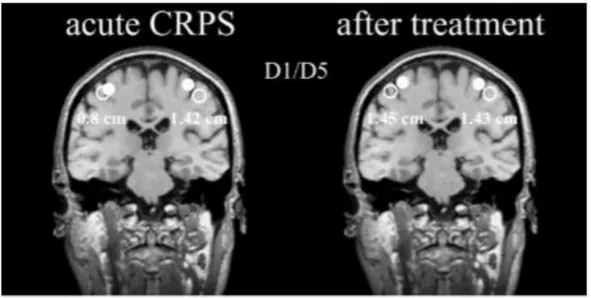 Figure 11: Réorganisation corticale et plasticité cérébrale dans les ADs :  Distance entre les zones de  réponse du cortex somatosensoriel à la stimulation du pouce (D1) et de l’auriculaire (D5) sur un membre  atteint de SDRC en comparaison avec le membre 
