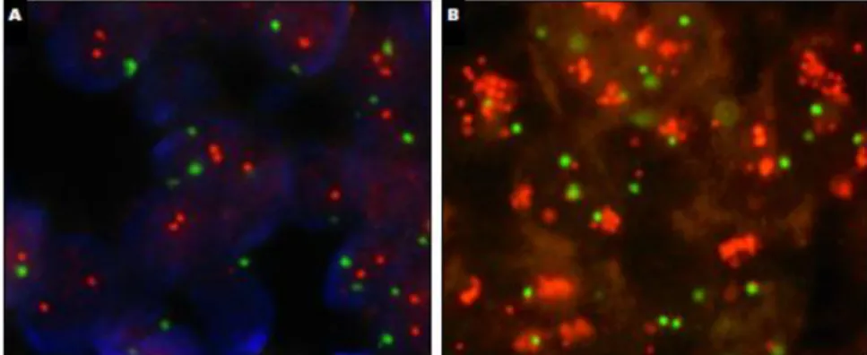 Figure  13  :  Evaluation  de  l'amplification  génique  de  HER2   par  FISH  A :  Carcinome  du  sein  sans  amplification génique présentant un ratio HER2(rouge)/CEP17(vert) &lt;2 B : Carcinome du sein avec  amplification génique présentant une augmenta