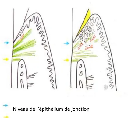 Figure 11 : Installation de la gingivite (Bercy &amp; Tenenbaum, 1996)  