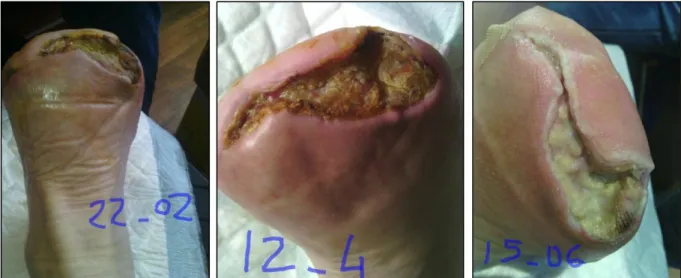 Figure 6 : Photos d'un moignon d'amputation 