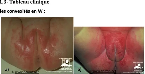 Figure 22 - a et b) - Dermites d'irritation formant un W (14)  