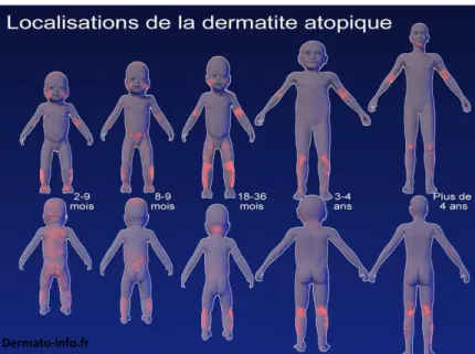 Figure 31 - Topographie des lésions de la dermatite atopique en fonction de l'âge (39)  Chez  le  nourrisson,  les  lésions  touchent  de  façon  symétrique  certaines  parties  du  visage :  zones bombées (front, menton, joues) et les membres