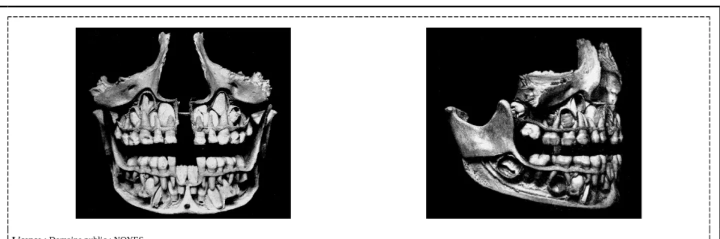 Fig. 9 Vues antérieure et droite d’une partie de la face disséquée d’un enfant. [29]