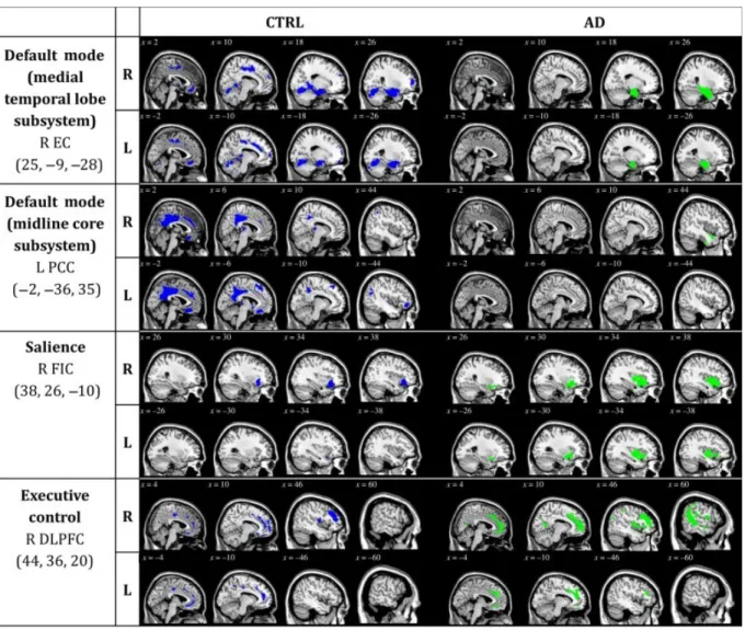 Figure 2. Statistical maps depict brain regions in which gray matter intensity covaried with that of the seed region of interest (ROI; listed at left) in each group