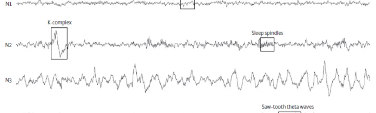 Figure  1.  Extrait  d’EEG  illustrant  chacun  des  stades  du  sommeil  ainsi  que  l’activité  typique de l’éveil