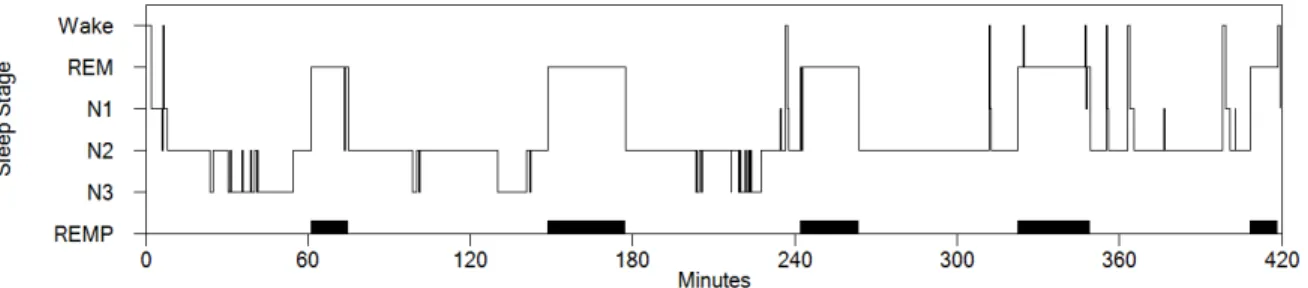Figure 2. Hypnogramme typique de l’adulte sain, représentant la succession des cycles  de  sommeil  selon  la  progression  des  minutes  de  sommeil  (axe  horizontal)