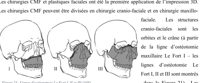 Figure 21: Lignes d'ostéotomies Le Fort I, II et III (105) 