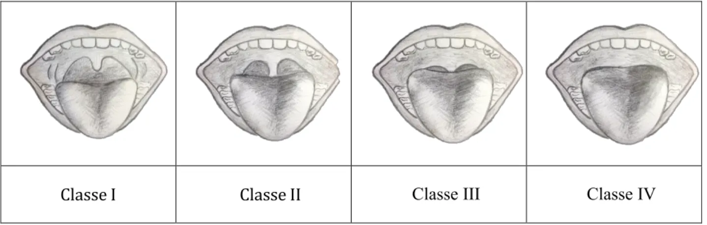 Figure 1: La classification modifiée de Mallampati  ( Mallampati-Score.png (PNG Image, 900 × 291 pixels)  [http://www.beverlyhillstmjheadachepain.com/Mallampati-Score.png]