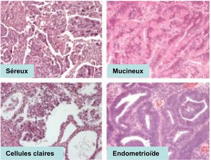 Figure 1. 1 Coupes histologiques des quatre principaux types histopathologiques du  cancer épithélial de l’ovaire (Bast et al., 2009)