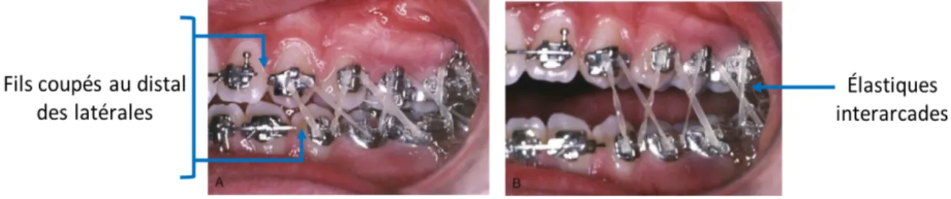 Figure 5.  Élastiques verticaux pour améliorer l’inter-digitation des dents en  finition 