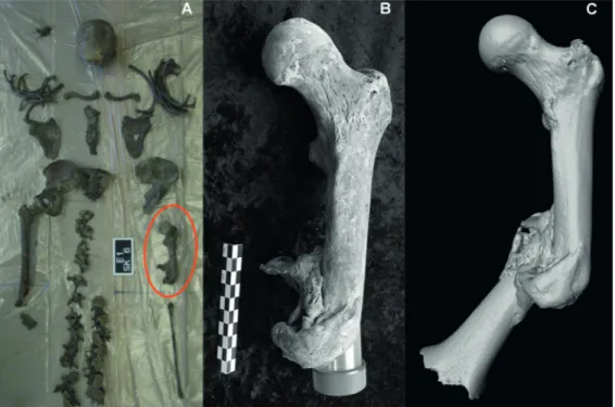 Fig. 1. Squelette complet de l’individu n° 6 de la fosse n° 1 (A) ; partie proximale du fémur ayant été  initialement interprétée comme une amputation (B) ; partie distale ré-associée témoignant d’une fracture  complexe du fémur (C).