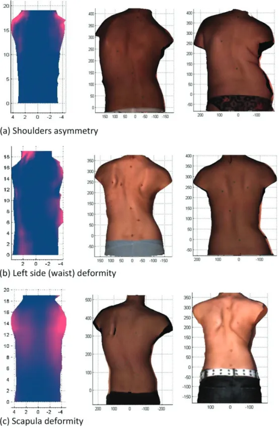 Fig. 3. Illustration of three independent components which capture the shoulder asymmetry,the scapula deformity and the waist deformation.