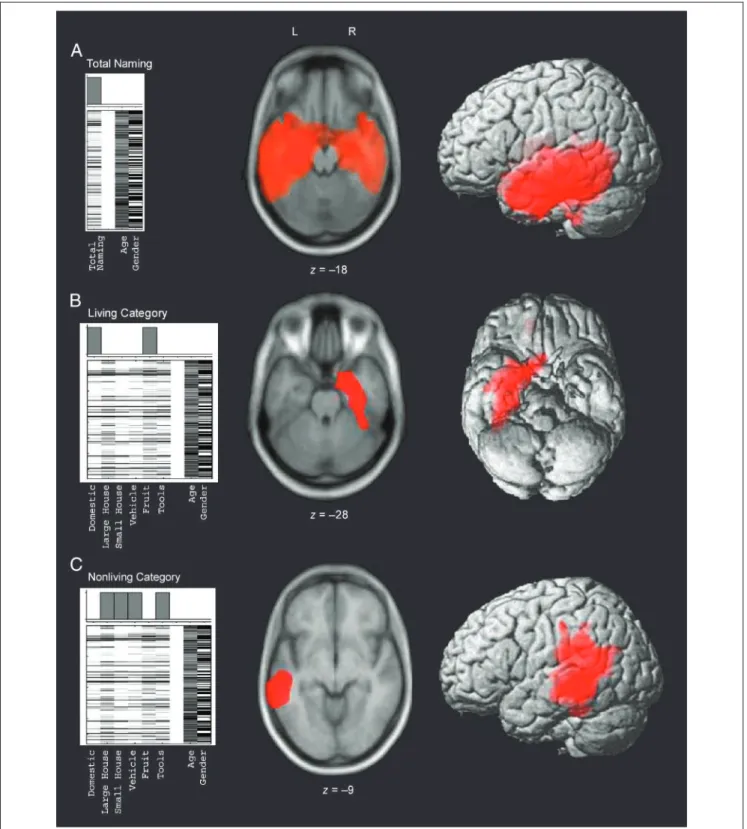 Figure 1. Brain areas that positively correlate with: (A) total naming score; (B) living scores; (C ) nonliving scores