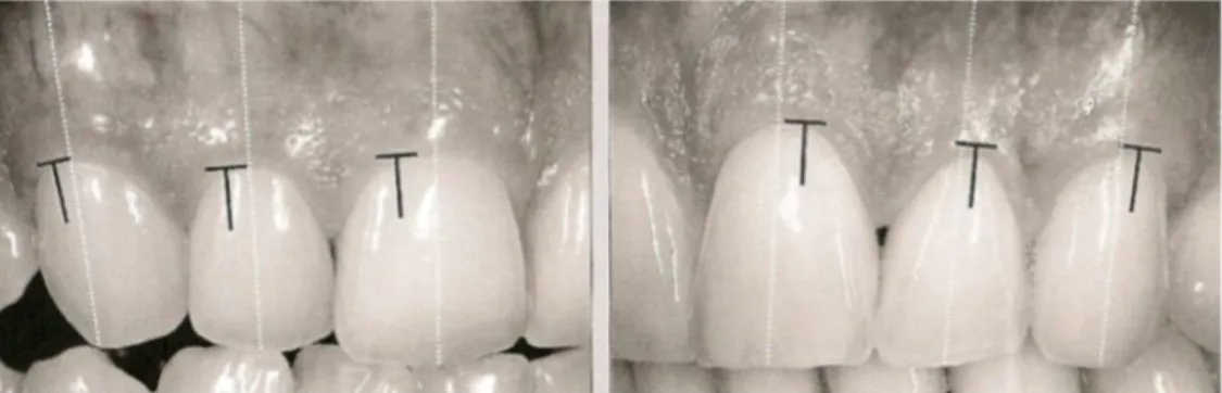 Figure 9 : Zénith en noir par rapport à l’axe de la dent (Magne P et BELSER 2003) 
