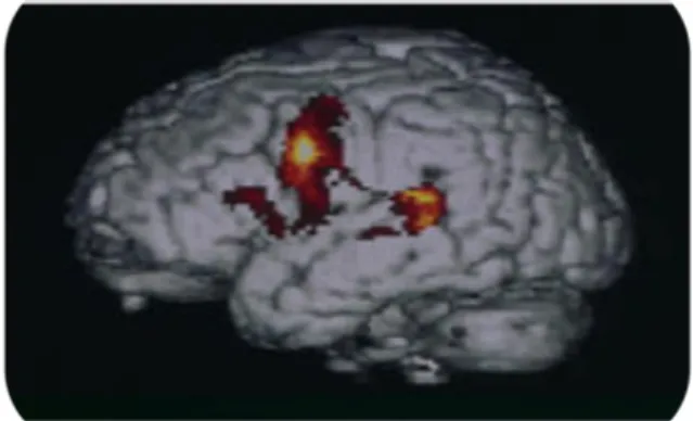 Figure 7 : Enregistrement de l’activité cérébrale par TEP chez deux sujets montrant un déficit de connexion  entre les aires visuelles et du langage chez le patient dyslexique (Inserm, 2014)