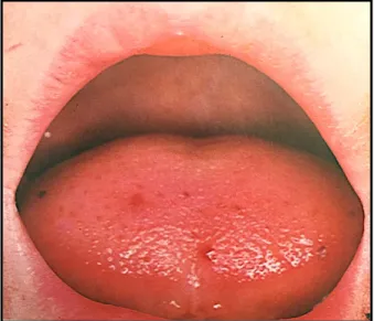 Figure 7 : Pétéchies sur la langue chez un enfant due à un PTI (Bain 1986) 