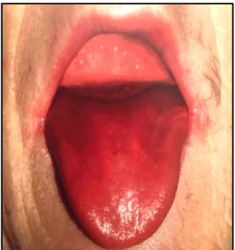 Figure 9 : Anémie ferriprive : exfolliation et érythème diffus de la langue avec perlèche bilatérale   (femme 78 ans) (Kuffer et al