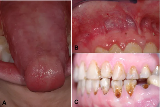 Figure 17 : Cliché illustrant les séquelles orales de NET :   (A) langue dépapillée et fibrosée chez une patiente de 11 ans ;   (B) brides cicatricielles chez un patient de 17 ans ;  