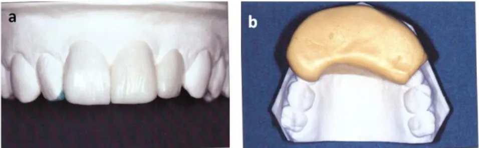 Figure 6 : Céroplastie prospective (a) et clef en silicone réalisée sur le modèle (b)  (Hammerle et al
