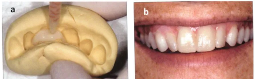Figure 7 : Clef en silicone permettant la réalisation du masque esthétique « mock up » en  résine auto polymérisable (a) en bouche (b) (Hammerle et al