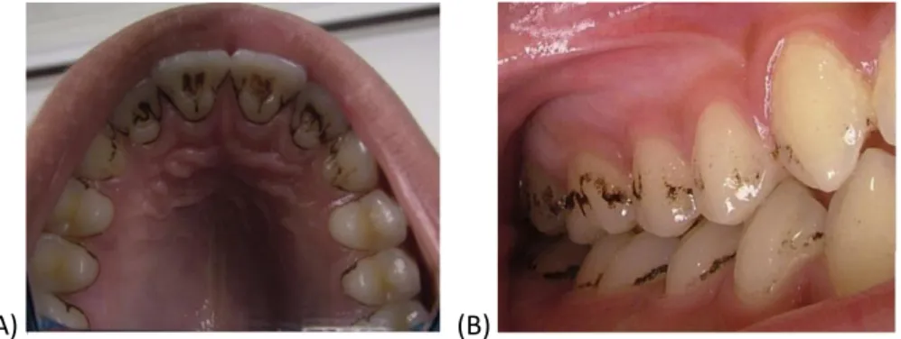 Figure 2 : Différentes localisations de BS en denture permanente 