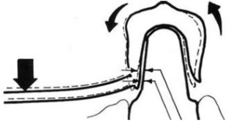 Figure 11 : Couronne télescopique résiliente avec un espacement en zone cervicale. 