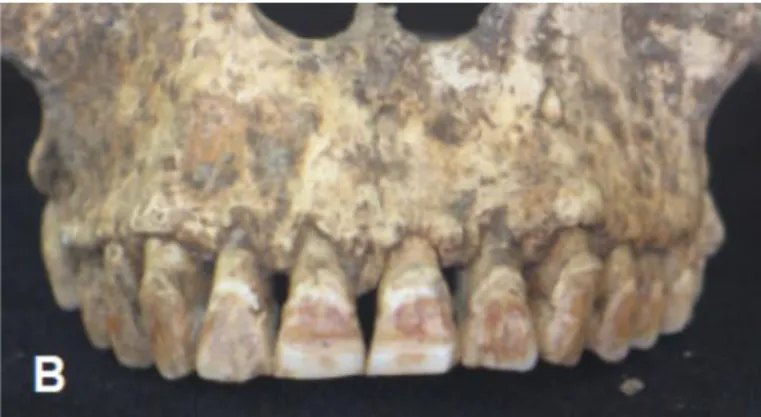 Figure 8 : Obturations dentaires et noircissement dentaire sur un crâne datant du mésolithique  retrouvé sur les îles Flores en Indonésie 