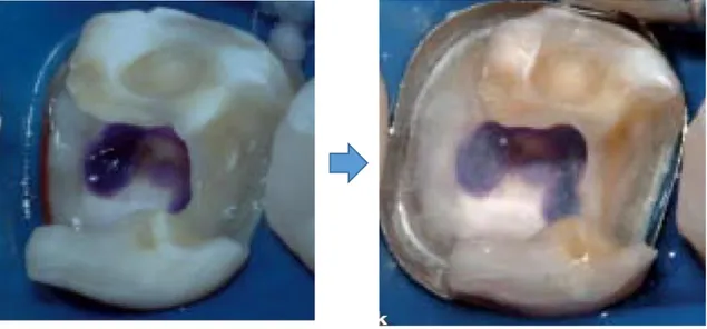 Figure 5 : Photographies illustrant le bon positionnement de la matrice complétant l’isolation 