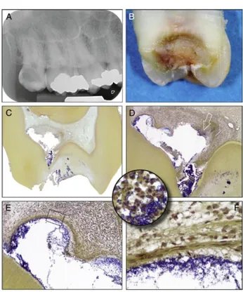Figure 5 : Radiographie rétro-alvéolaire, coupe dentaire et coupe histologiques au stade de pulpite  aigue irréversible  