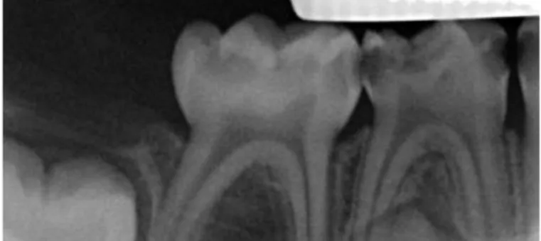 Figure 8 : Radiographie rétroalvéolaire – Ayan M., âgé de 3 ans 