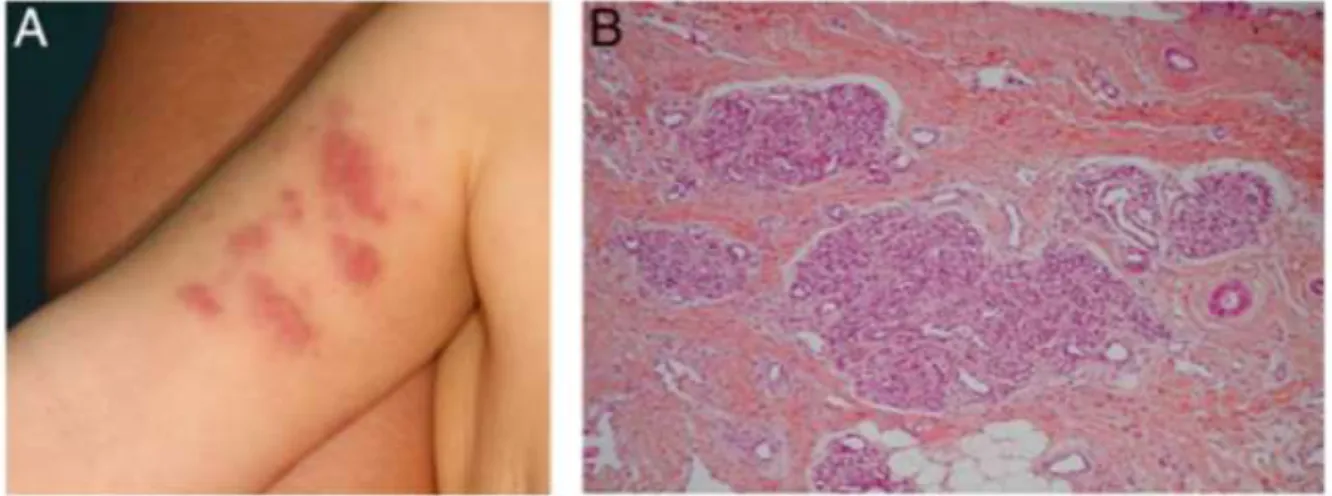 Figure 7 : Hémangiome en touffe ; A, lésion vasculaire rouge avec une texture de cuir au niveau du  bras ; B, Coupe histologique de la lésion vasculaire 