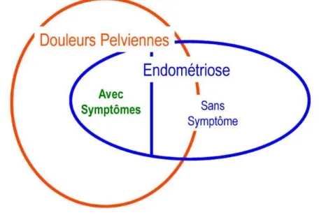 Figure 2 : Modèle de relation entre endométriose et algie pelvienne chronique selon Hurd  (24)