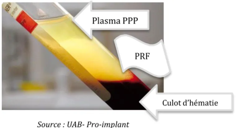 Figure 11: Après la centrifugation, trois fractions identifiables: en haut le plasma pauvre en  plaquette (PPP), en bas le culot d'hématie et au centre le caillot de fibrine, le PRF