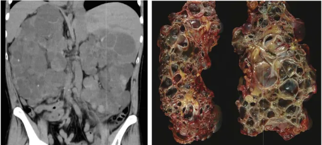 Figure 2: Kystes rénaux multiples dans le cadre d’une PKR Le diagnostic de PKRAD repos