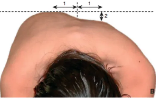 Figure 5 : Déformation dans le plan horizontal avec présence d'une gibbosité  dont on peut mesurer l’amplitude (notée  « 2 ») (4) 