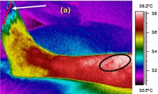 Figure 8 : images thermiques typiques de région la plantaire chez deux patients diabétiques  (Bagavathiappan et al