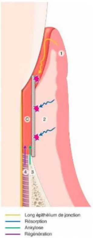 Figure 5 : Principe de la régénération tissulaire guidée 