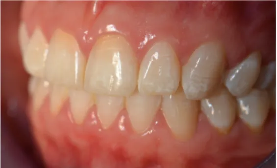 Fig.  :  1.8.  Caractérisations  blanches  sur  les  faces  vestibulaires  dentaires  liées  à  une  fluorose  légère  (Courtoisie du Dr Aude Simon) 