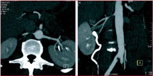 Figure 8 : Angioscanner d’une sténose de l'artère rénale droite 12 .  c.  Angio-IRM des artères rénales : 