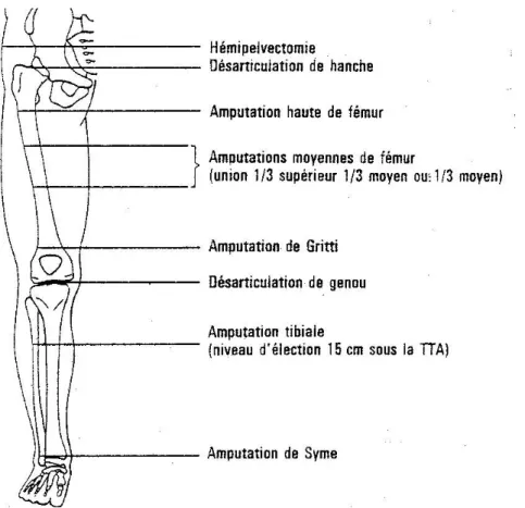 Figure 2. Les différents niveaux d’amputation du membre inférieur.  