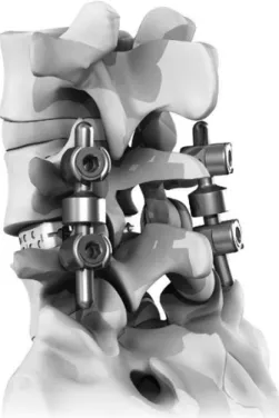 Fig. 5 : Le système Isobar TTL®. 