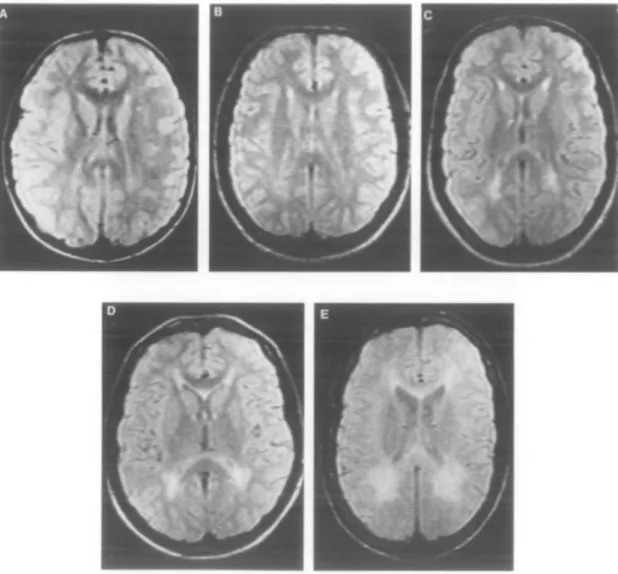 Figure D. Anomalies de signaux par IRM en séquence T2 chez des patients atteints de  phénylcétonurie allant du grade A (atteinte la moins sévère) au grade E (atteinte la plus  sévère) (Thompson et al