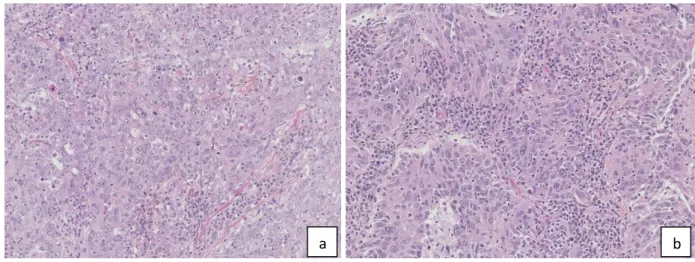 Figure 2 : Coloration HES, grossissement x 20 : Aspect morphologique d’un carcinome du sein triple  négatif (a)  et  d’un adénocarcinome pulmonaire TTF1 négatif de sous-type solide (b) 