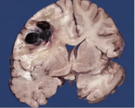 Figure 9 : Foyer de mélanome métastatique impliquant le lobe frontal au niveau de la commissure antérieure  avec hémorragie associée et œdème environnant [20]