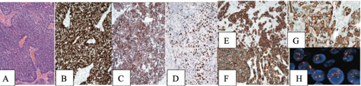 Figure 11 :Carcinome pulmonaire métastatique à petites cellules. 