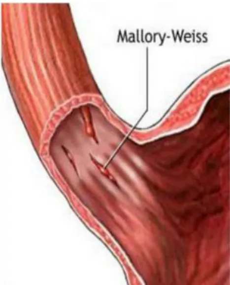 Figure n°1 : Représentation anatomique du syndrome de Mallory-Weiss  