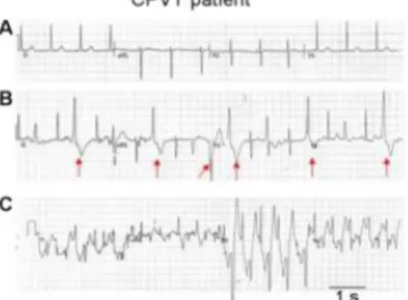 Figure 11  :  Tracé  électrocardiographique  de  tachycardie  ventriculaire  lors  d’une  épreuve d’effort (d’après Faggioni et al