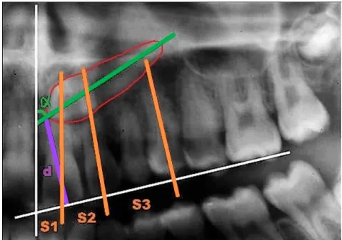 Figure 2 : Influence de la localisation de la canine incluse   sur la durée de traitement orthodontique 18